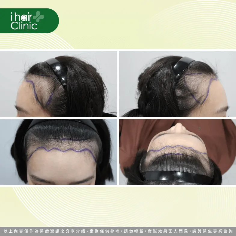 實際劃出規劃植髮的區域 植髮填補區域畫線-台北女性植髮推薦