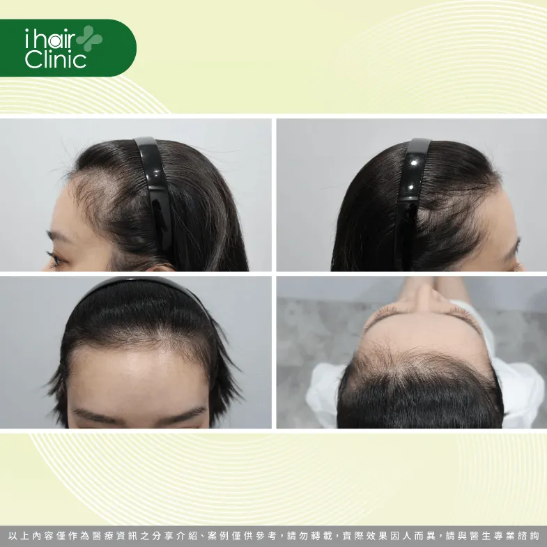手術之前的前額髮量稀疏,可以明顯看到額角缺空 手術前髮量-台北女性植髮推薦
