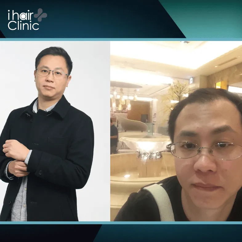 素人欣欣植髮分享,1年後效果有成 欣欣植髮分享-ARTAS 植髮