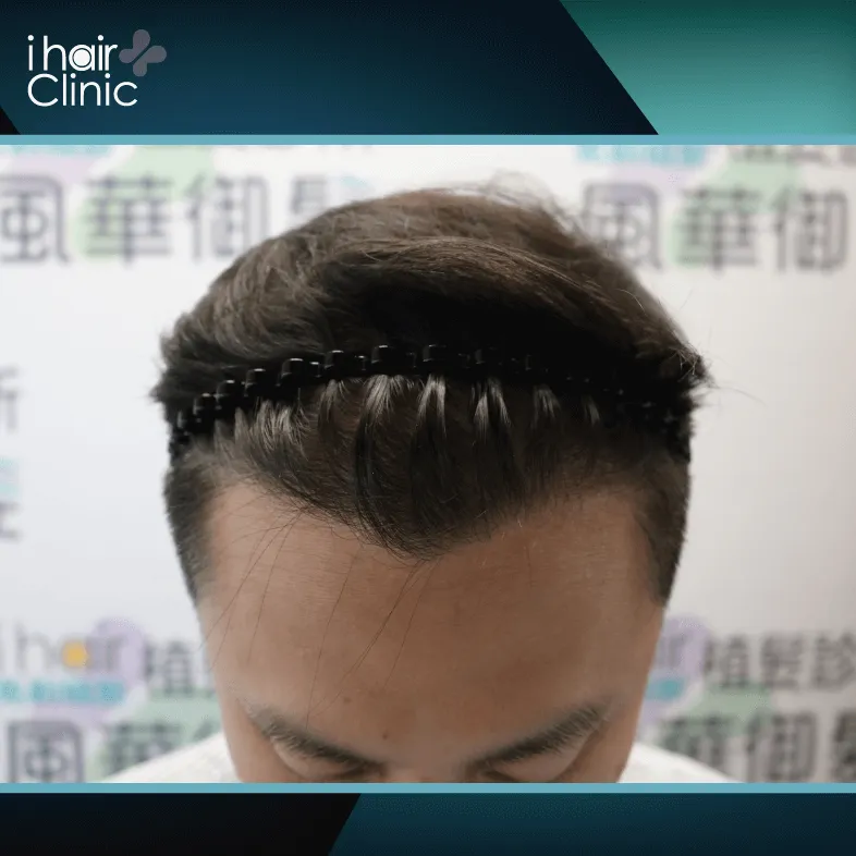 植髮後一年髮際線更順暢,再也不必擔心不上相的問題 植髮後一年效果-植髮推薦
