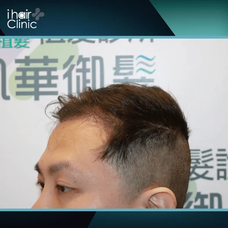 髮際線持續倒退的欣欣,下定決心透過植髮改善現況 欣欣前額禿髮狀況-ARTAS 植髮
