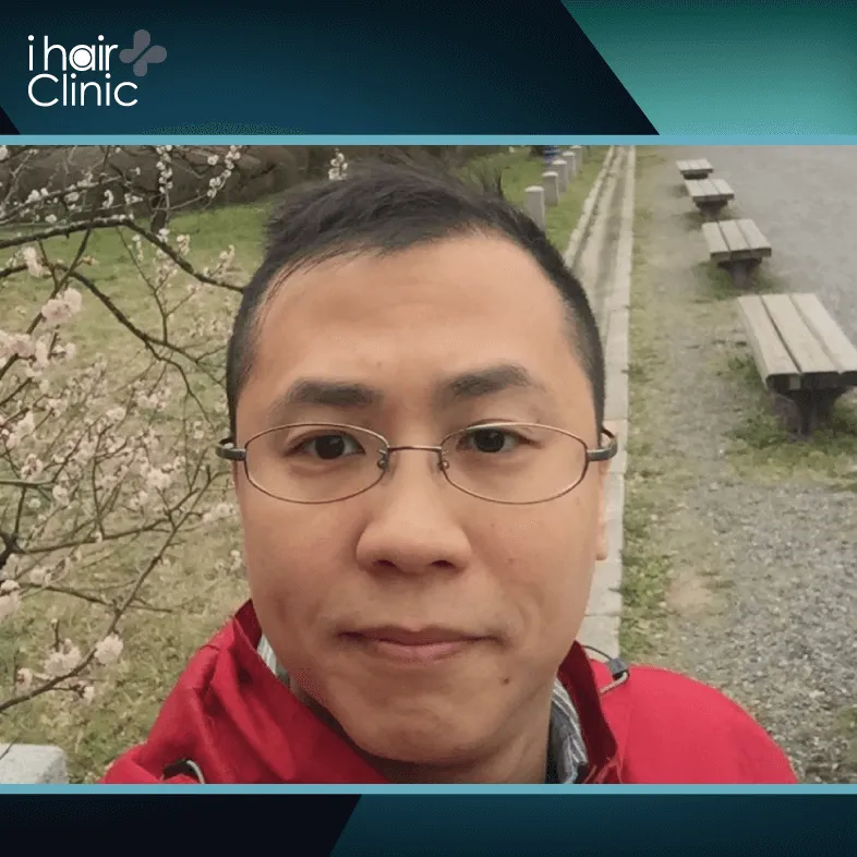 長期受到髮際線禿髮困擾的欣欣,自信心大大下降 欣欣禿髮狀況-ARTAS 植髮