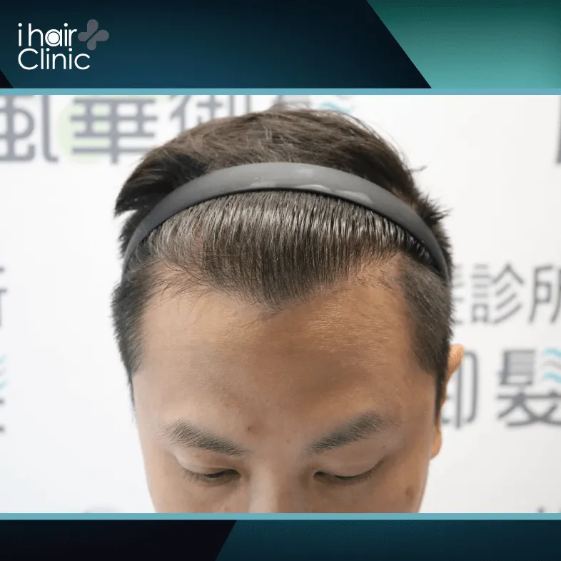 透過植髮手術順利填補前額禿髮部位 植髮後效果-植髮推薦