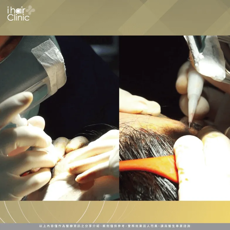 採用免剃植髮的馮光榮在手術過程中採小區域麻醉,安全又放心 藝人植髮-植髮推薦