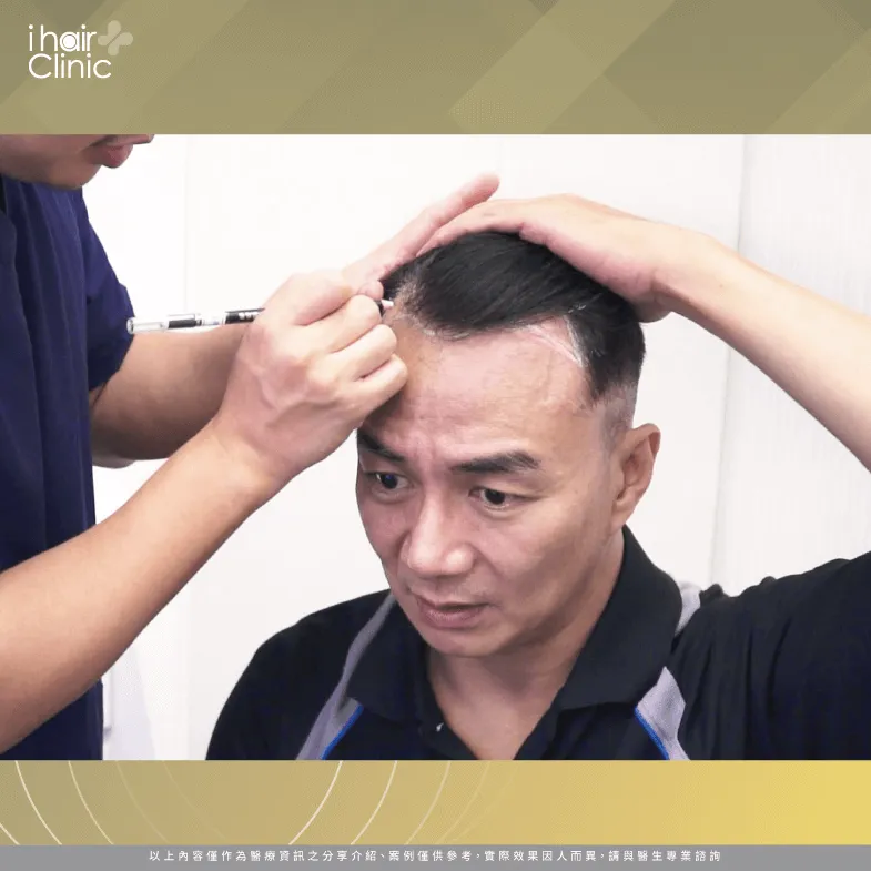 透過植髮診所現場專業人員的解說,讓馮光榮更加信任! 藝人植髮諮詢-植髮推薦