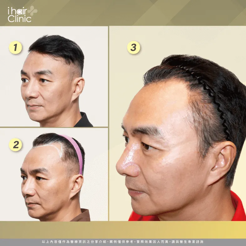 透過ihair風華御髮診所的協助,讓馮光榮的額角髮絲回到該去的位置! 藝人植髮過程-植髮推薦