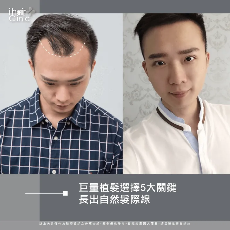 植髮5大關鍵-台北植髮診所推薦