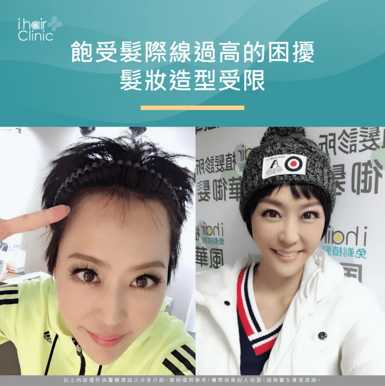唐玲因髮際線過高,髮妝造型受到限制,讓她困擾不已 髮際線過高導致髮妝受限-植髮體驗分享