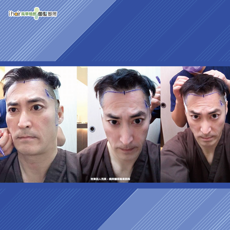 術前頭皮檢測-男性植髮