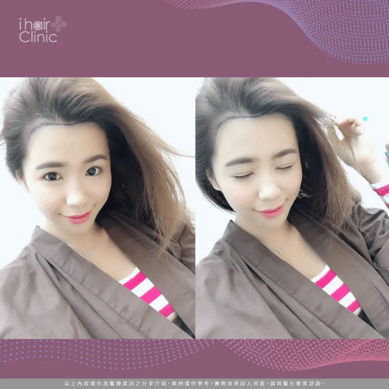 美型植髮術前規劃-免剃植髮