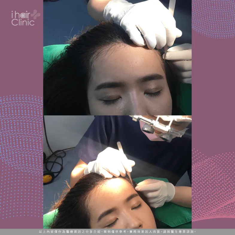 美型植髮過程中皆採坐式-免剃植髮