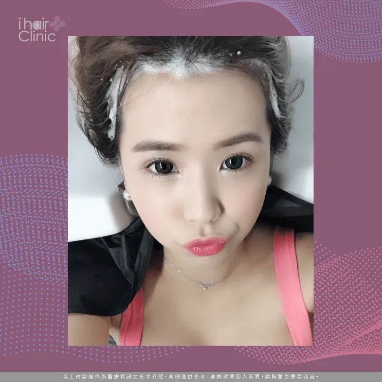 植髮後的養護療程也非常重要-免剃植髮