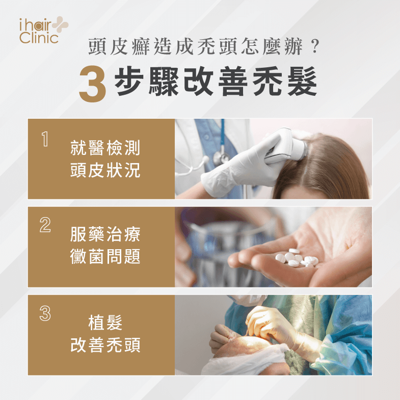 改善頭皮癬禿頭,馬上跟著3步驟做,緩解禿頭問題 3步驟改善禿髮-台北植髮診所推薦