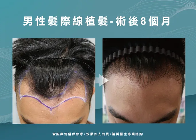 降低過高髮際線、填補額角，視覺減齡