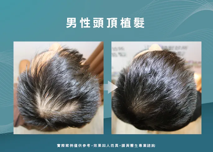 頭頂稀疏、分線明顯，植髮後頂上明顯增量