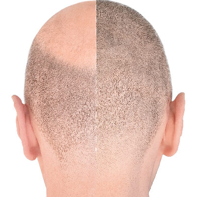 打造健康頭皮-桃園植髮術後保養