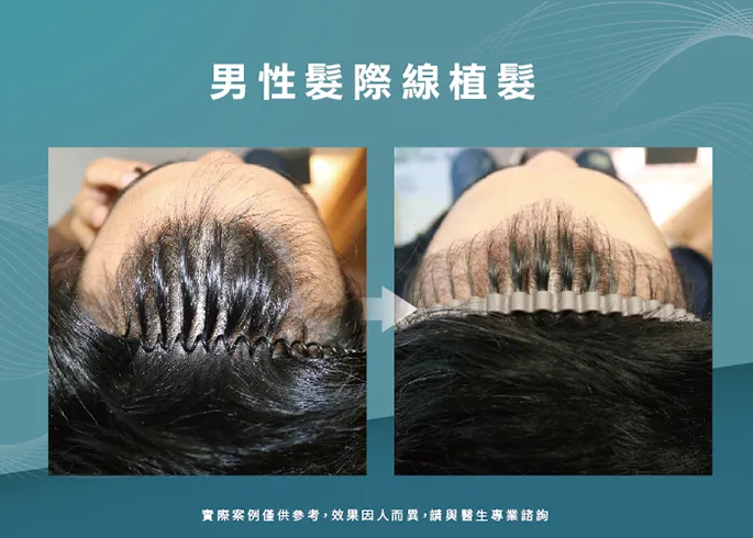 男性髮際線植髮-桃園植髮際線