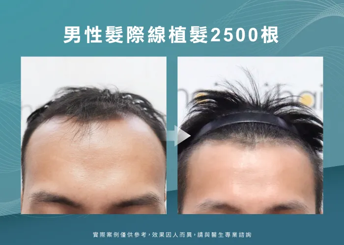 男性髮際線植髮-桃園植髮際線