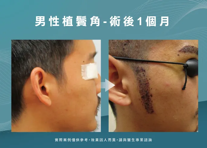 男性植鬢角一個月-桃園植鬢角推薦