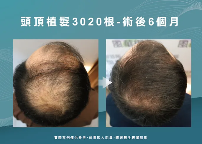 男性頭頂部植髮6個月效果-桃園植髮推薦