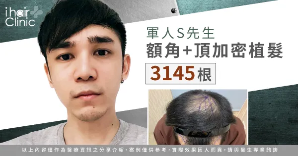 S先生男性植髮分享-男性植髮