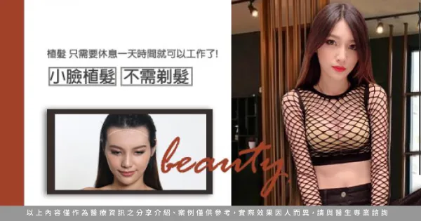 女性髮際線植髮-桃園髮際線植髮推薦