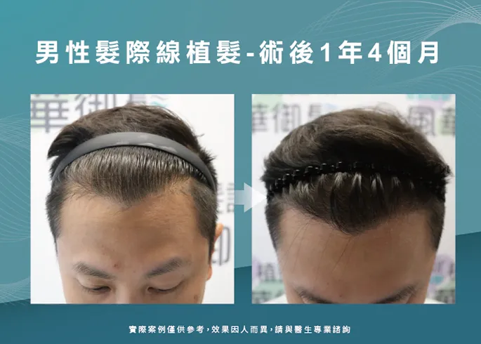 改善 M 型後退，重塑順暢髮線弧度